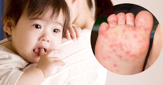 Hand, Foot and Mouth Disease Season is Here – What Parents Need to Know